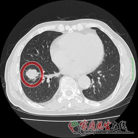 陶喆父親陶大偉肺癌病逝 肺癌篩查靠什么？