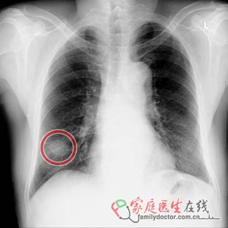 陶喆父親陶大偉肺癌病逝 肺癌篩查靠什么？